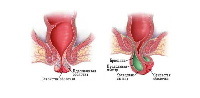 Ректальний пролапс: симптоми і лікування при випаданні прямої кишки у людини