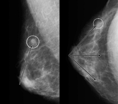 Як розшифрувати результат мамографії