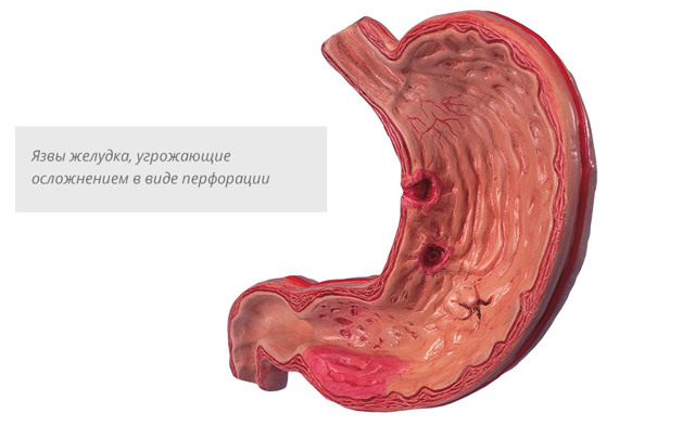 Виразка шлунка: симптоми, ознаки, методи діагностики і фактори, що провокують розвиток виразки