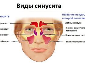 Гострий гайморит (верхньощелепної синусит): симптоми і лікування