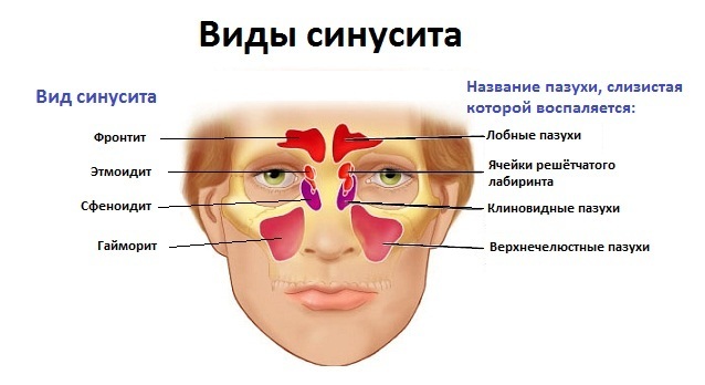 Гострий гайморит (верхньощелепної синусит): симптоми і лікування