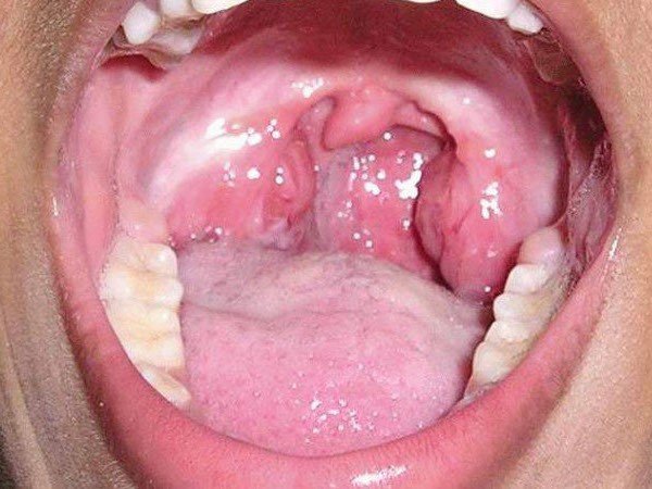 Рак горла: симптоми і прояви на різних стадіях у чоловіків і жінок