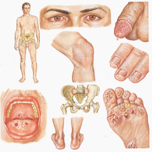 Венеричні захворювання у чоловіків і жінок: симптоми венеричних захворювань, діагностика та лікування ЗПСШ.