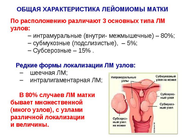 Лейоміома шлунка: що це таке, симптоми і лікування, профілактика