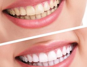 Лазерне відбілювання зубів: плюси і мінуси, відміну від фотовідбілювання