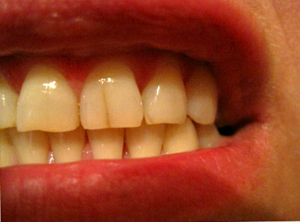 Тріщини на зубах: причини появи і види, способи лікування і профілактики