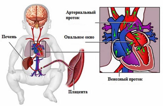 Причини шумів в серці у дитини (новонародженого і грудного)