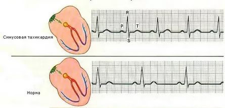 Як розшифрувати ЕКГ серця і діагностувати патології серця по ЕКГ