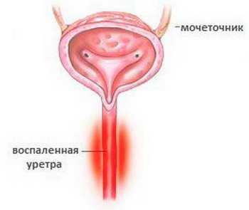 Травма уретри, сечовипускального каналу у чоловіків і жінок: симптоми, лікування