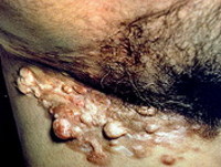 Вибухає дерматофібросаркома шкіри: причини, симптоми, лікування, прогноз, виживаність