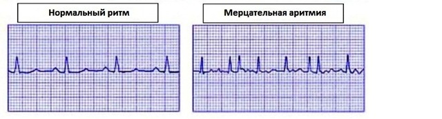 Розшифровка ЕКГ: норма кардіограми серця, як розшифрувати її самостійно