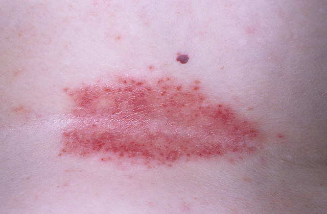 Інтертрігинозний псоріаз складок шкіри: причини, симптоми, лікування, діагностика