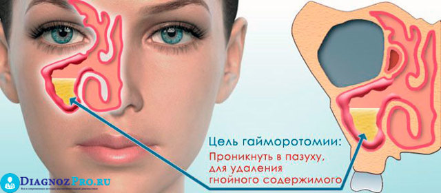 Ендоскопія пазух носа: опис і застосування методу
