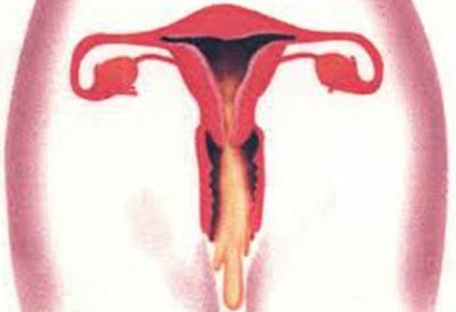 Гонорея у жінок: перші ознаки, симптоми і лікування, фото виділень при гонореї