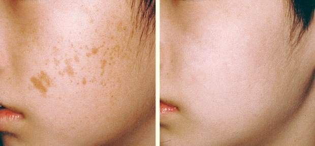 Лазерна шліфовка рубців на обличчі й тілі: протипоказання, фото до і після