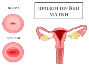 Ерозія шийки матки у родили: лікування та причини