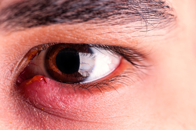 Опух очей і болить: причини, як позбутися, методи усунення і лікування набряку