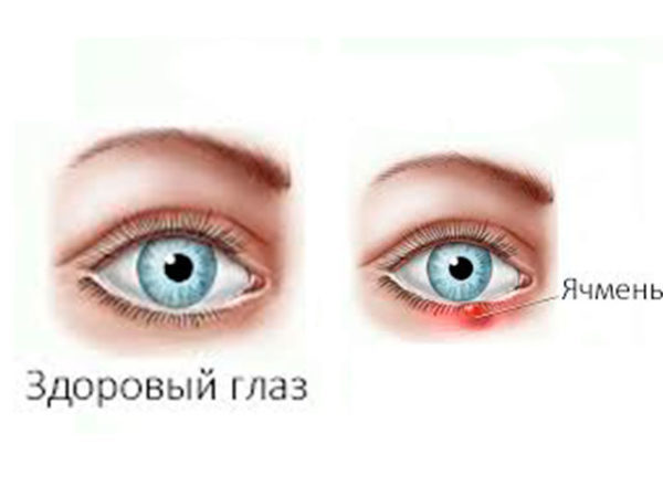 Ірит очі: симптоми і лікування, причини, як лікувати ірит у дитини
