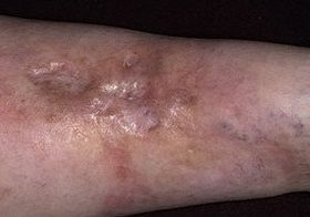 Ліпоїдний некробіоз шкіри: фактори ризику, клінічні прояви, діагностика і принципи лікування