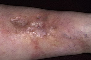 Ліпоїдний некробіоз шкіри: фактори ризику, клінічні прояви, діагностика і принципи лікування