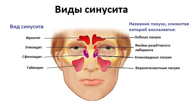 Вірусний гайморит і синусит: симптоми і лікування