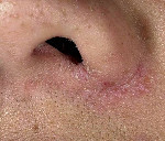 Екзема передодня носа: симптоми, причини і лікування екземи передодня носа