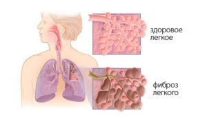Фіброз легенів: що це таке і як лікувати, симптоми фіброзу легенів і лікування
