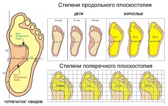 Порожня стопа: що це таке, симптоми і лікування, чи можлива служба в армії