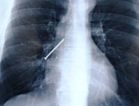 Розрив легені: причини пошкодження, клінічна картина, методики лікування і можливі наслідки