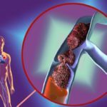 Посттромбофлебітична хвороба вен нижніх кінцівок: симптоми, лікування