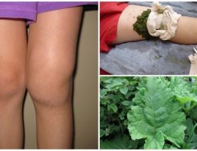 Лікування артрозу колінного суглоба: вправи, дієта, препарати при артрозі колінних суглобів