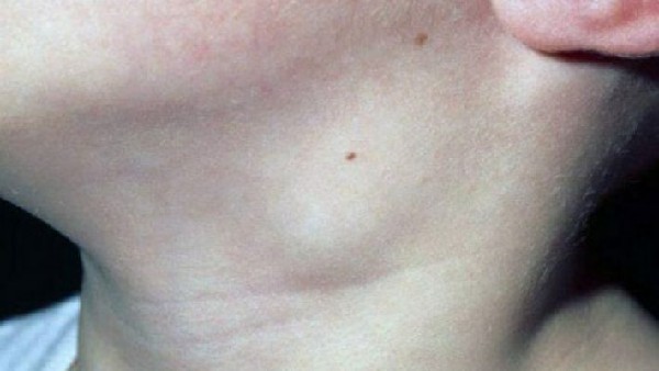 Ущільнення у вигляді кульки під шкірою на шиї збоку - що це може бути