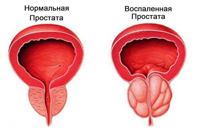 Ліки від простатиту: найефективніші препарати при хворобах передміхурової залози