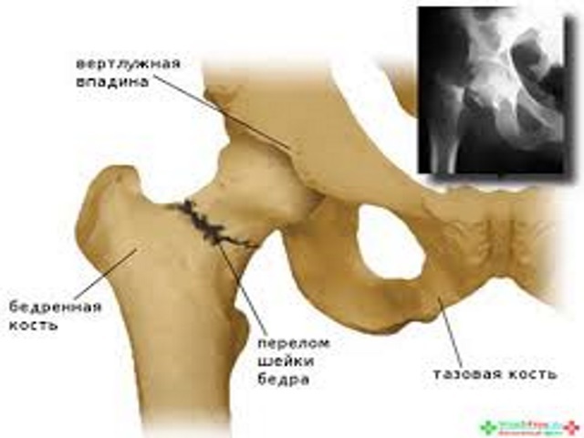 Внутрішньосуглобової перелом колінного, ліктьового суглоба, великогомілкової, променевої кістки