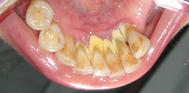 Зубний камінь: провокуючі фактори, симптоми появи, методи видалення в стоматології і в домашніх умовах