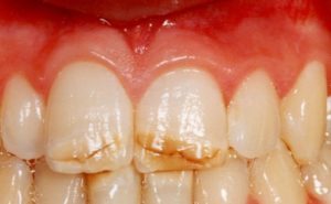 Тріщини на зубах: що це, що робити, як лікувати тріщина на емалі