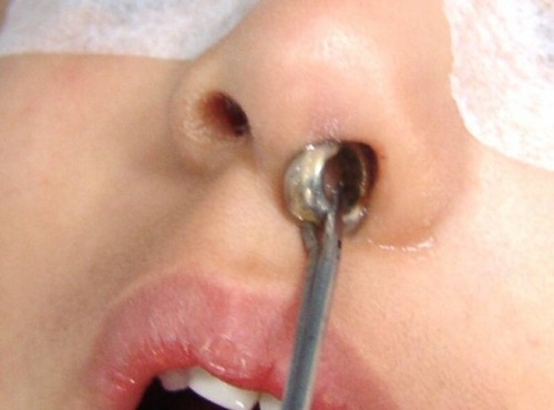 Чужорідне тіло в носі у дитини: симптоми, перша допомога, видалення стороннього тіла