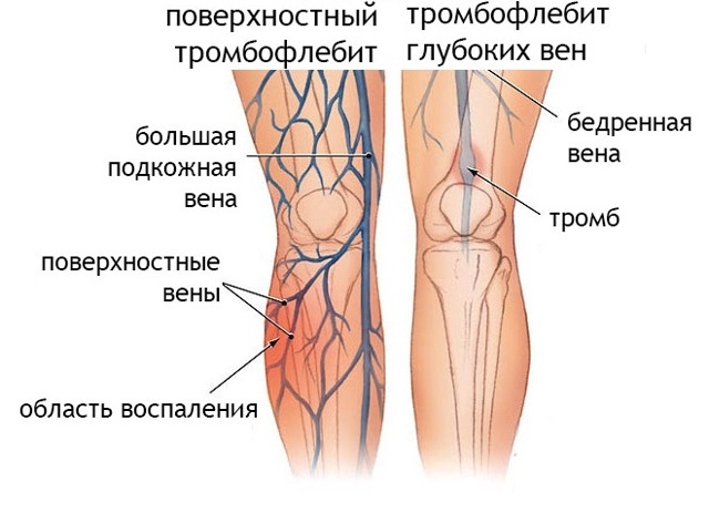 Як проявляється тромбоз і варикоз вен на ногах і руках