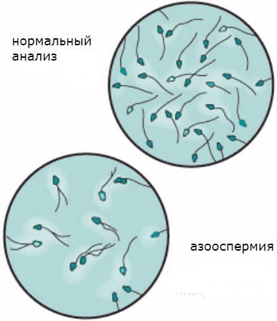 Азооспермія - лікування, причини, вагітність при азооспермії