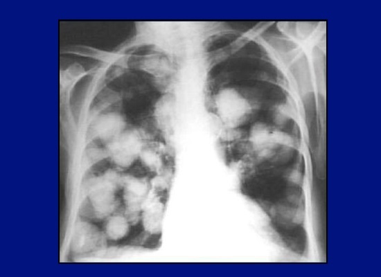 Рентген і флюорографія легень - свідчення, правила проведення та розшифровки результатів.