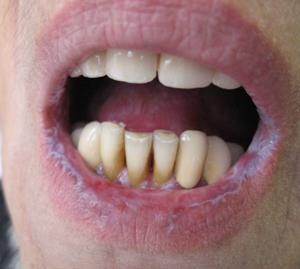 Червоний плоский лишай слизової рота і шкіри, симптоми і лікування