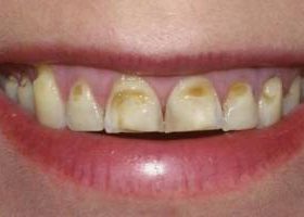 Ерозія зубної емалі - причини каріозного і некаріозного поразки