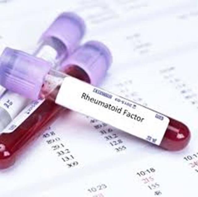 Аналіз крові на ревматоїдний фактор: що це таке, підготовка і розшифровка