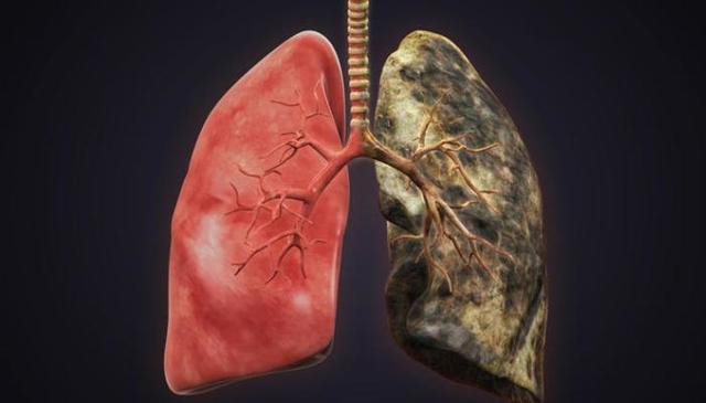 Рак легенів: відсоток виживання, термін життя при різних стадіях, діагностика
