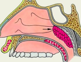 Пухлина носоглотки: симптоми і ознаки захворювання