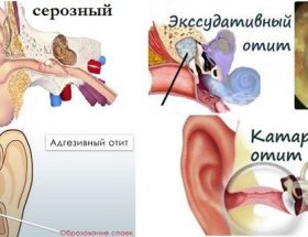 Середній отит вуха у дітей і дорослих: ознаки, діагностика, методи лікування і профілактики