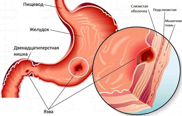 Відрижка - причини відрижки після їжі, відрижки тухлими яйцями, відрижки повітрям