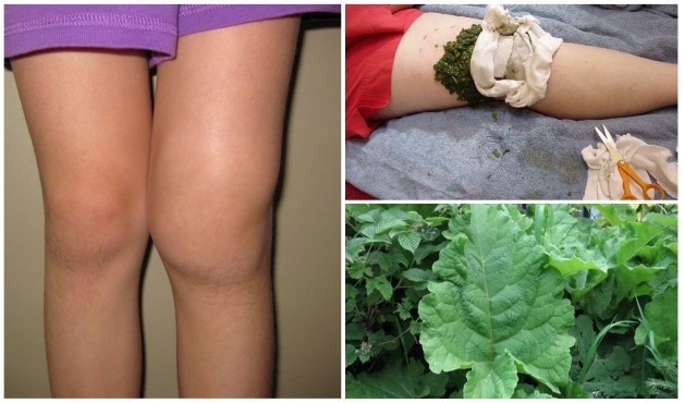 Лікування артрозу колінного суглоба в домашніх умовах: добірка рецептів