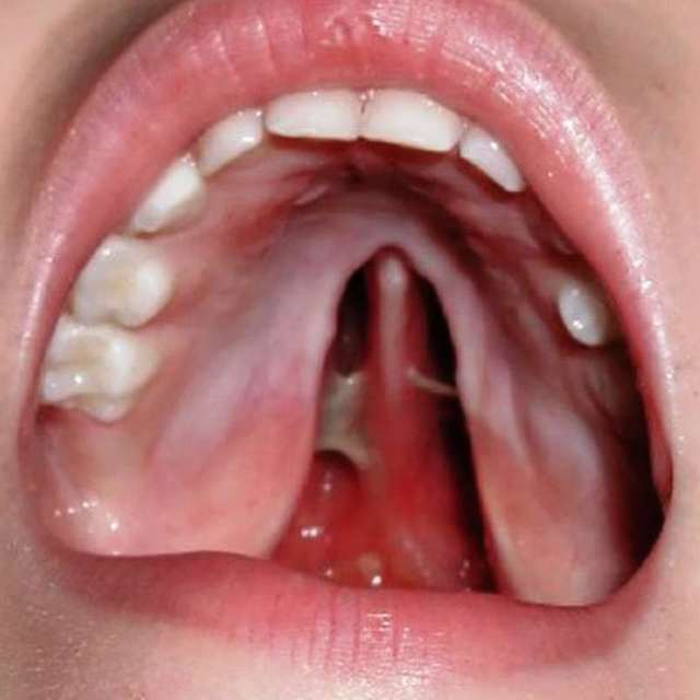 Заяча губа: причини виникнення, що робити, заяча губа до і після операції