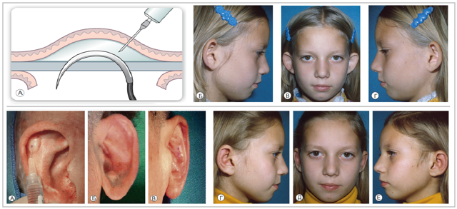 Великі, капловухий вуха - операція, виправлення форми вух, отопластика вух